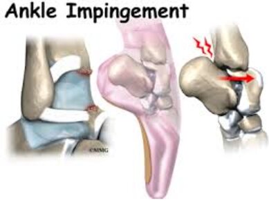 Nerve entrapments of the ankle